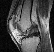 Meniscus Tears: Why You Should Not Let Them Go Untreated