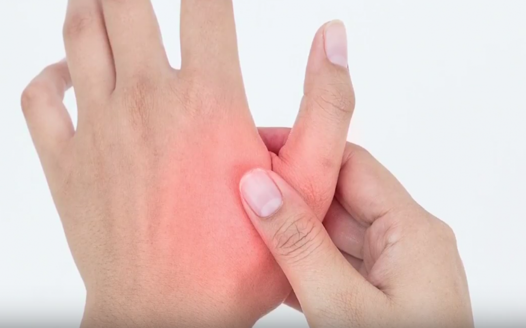 Thumb Arthritis