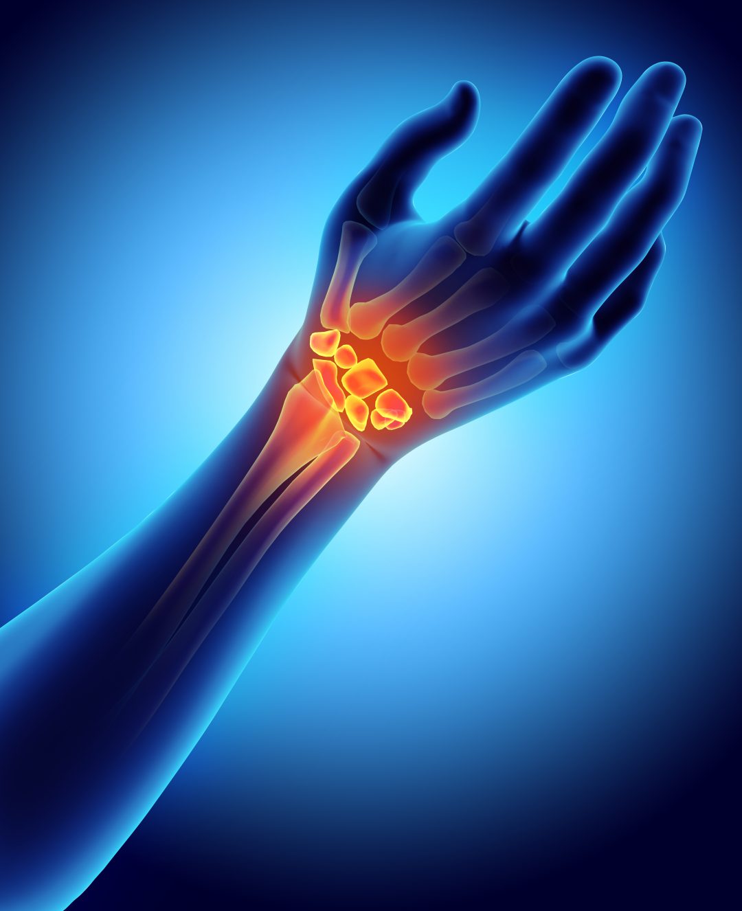 3D illustration of Carpal, medical concept. - AOA Orthopedic Specialists