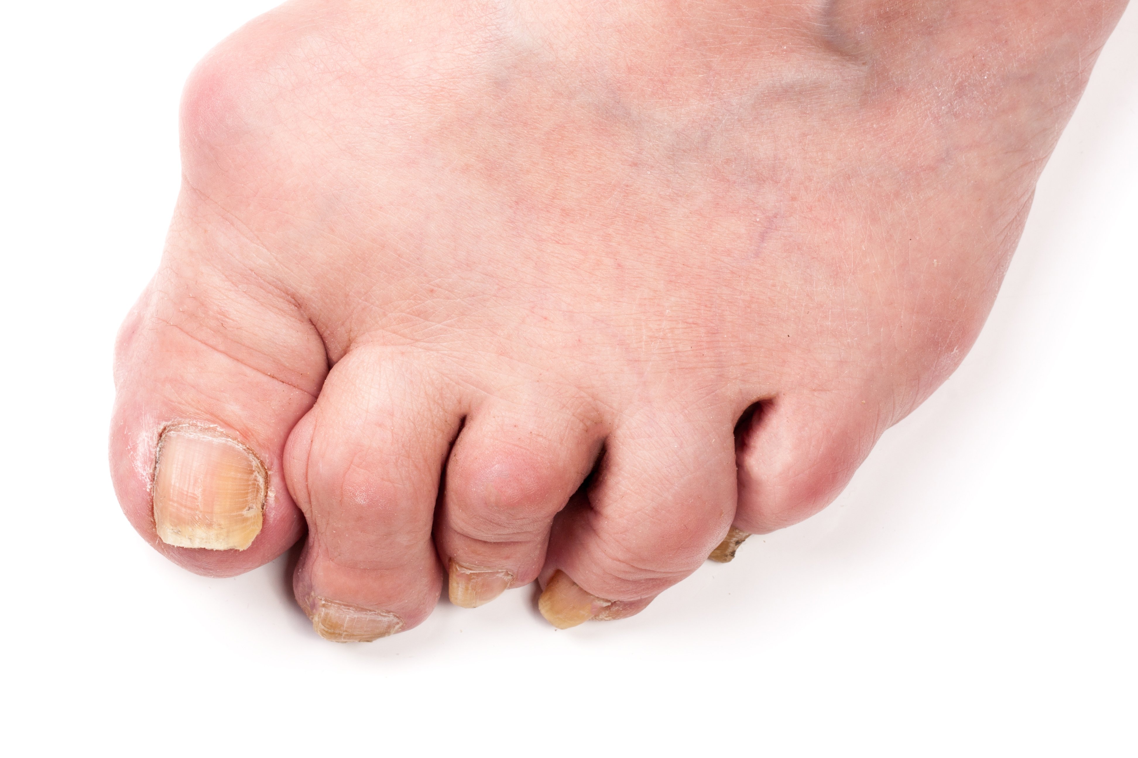 Hammertoe Correction - Arlington Orthopedics Associates, P.A ...