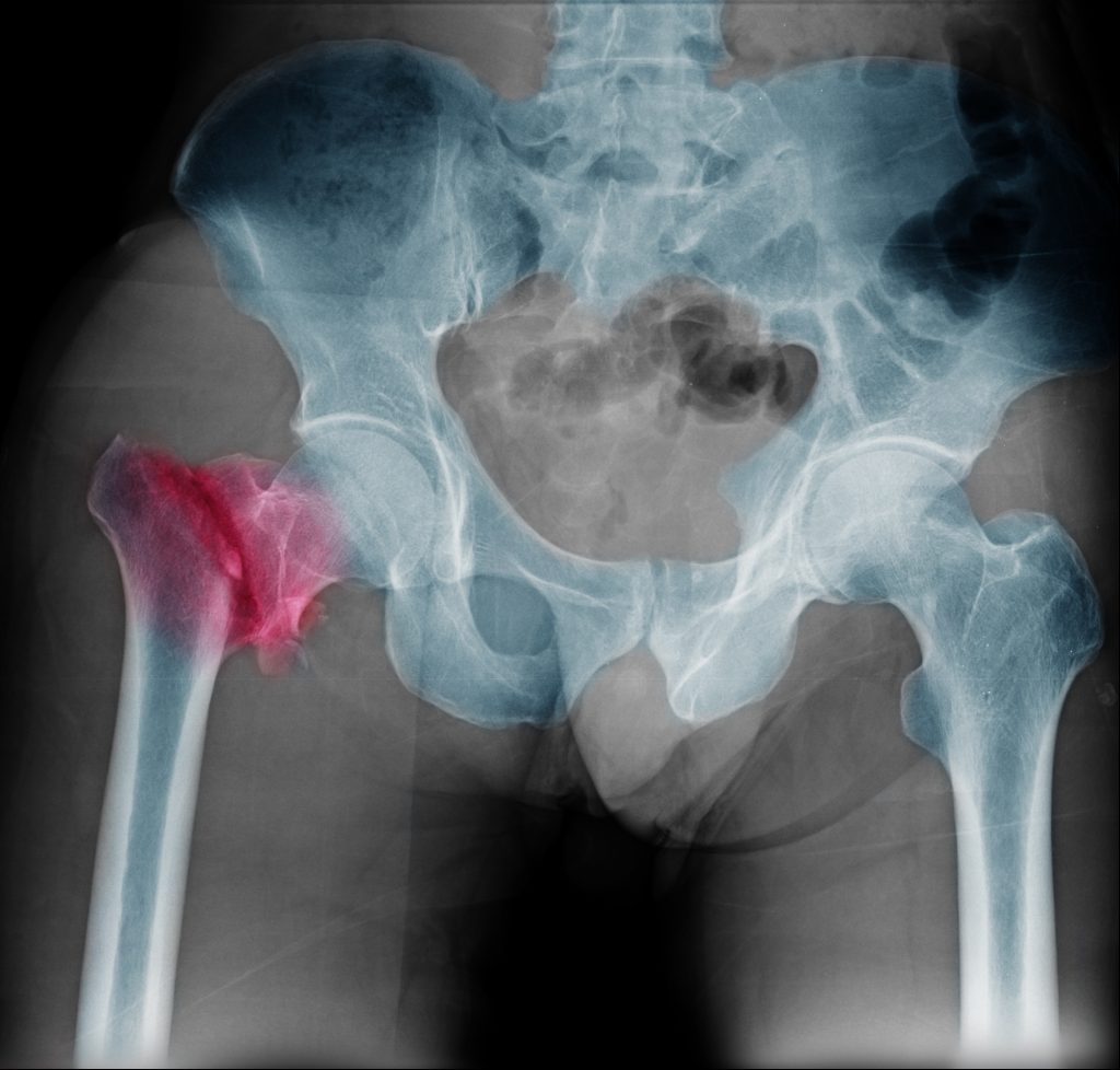 Hip fracture