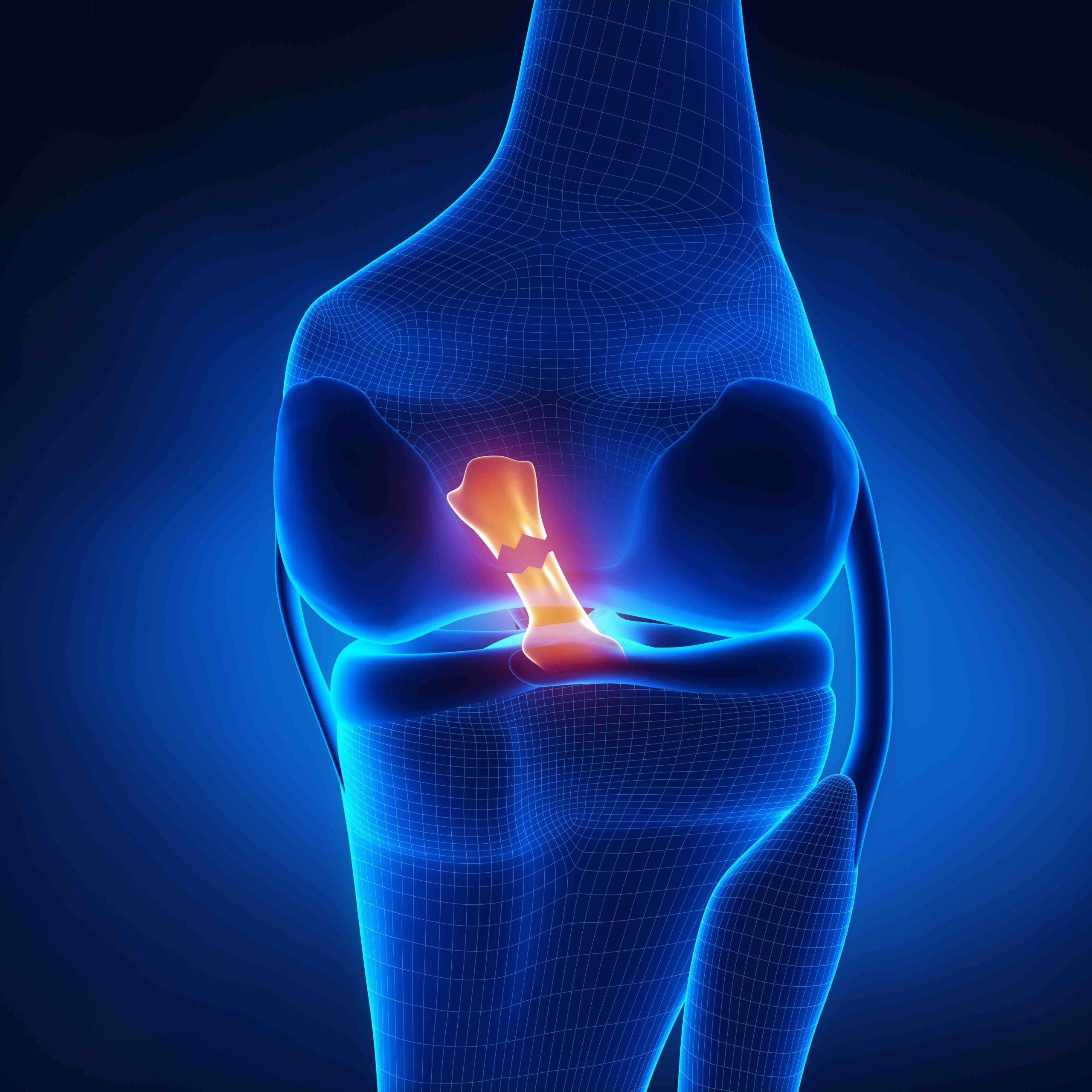 Patellar tracking disorder - AOA Orthopedic Specialists