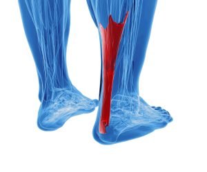 Achilles Tendor Repair