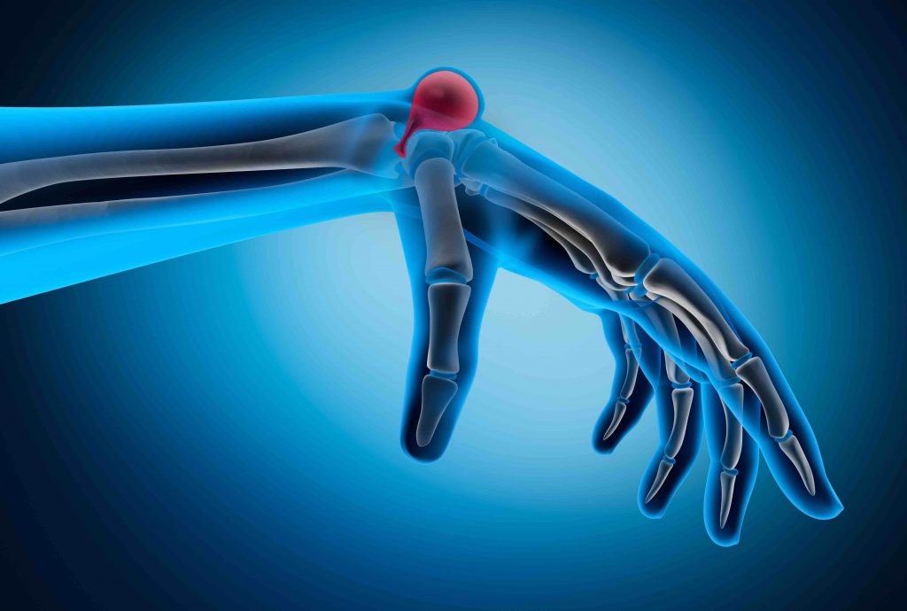 GANGLION CYST ON THE HAND - AOA Orthopedic Specialists