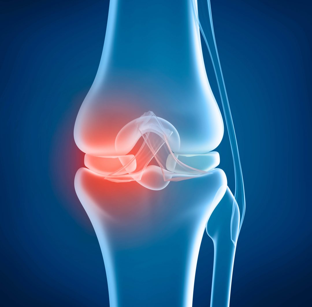 Knee problem, x-ray view - AOA Orthopedic Specialists