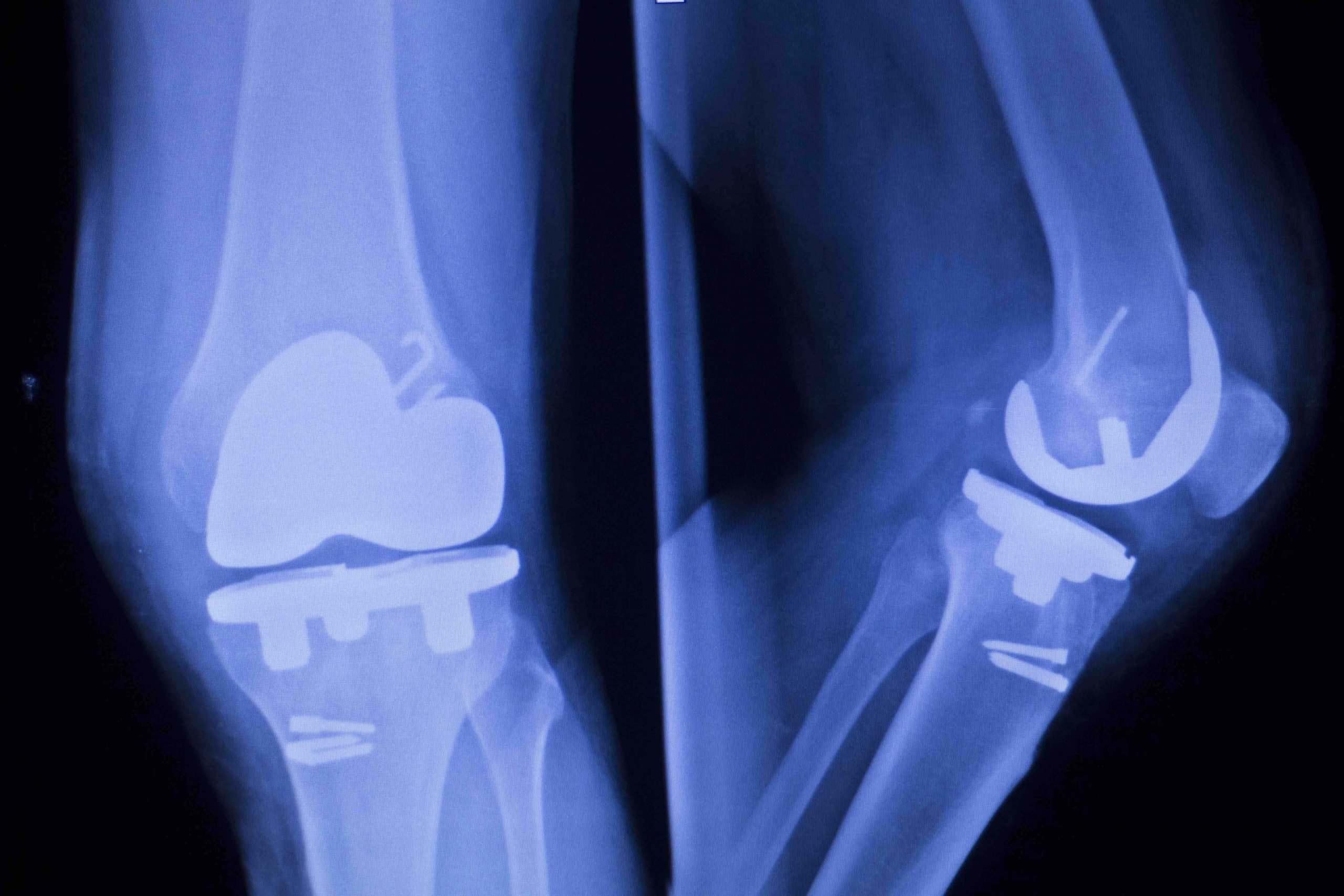 Knee joint implant replacement xray showing in medical orthpodedic traumatology scan.