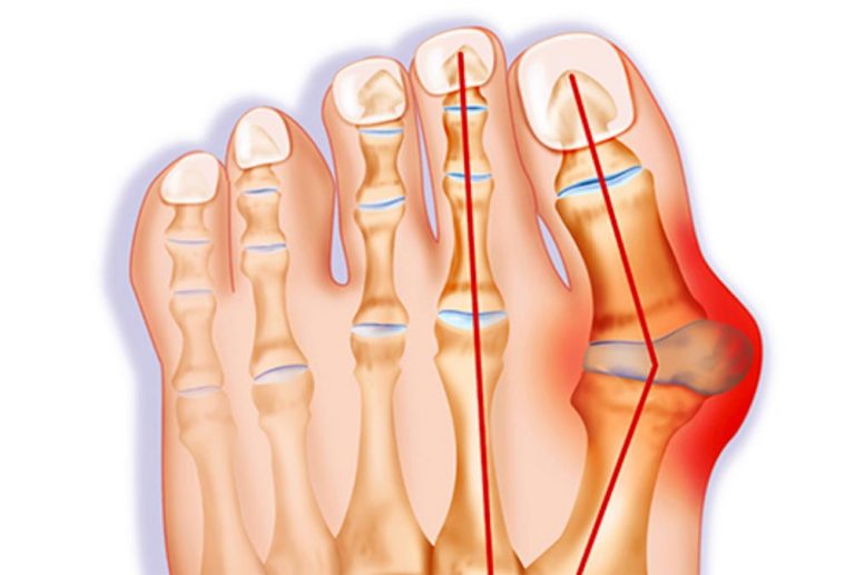 Foot And Ankle Bunion Correction With Scarf And Akin Osteotomy Aoa