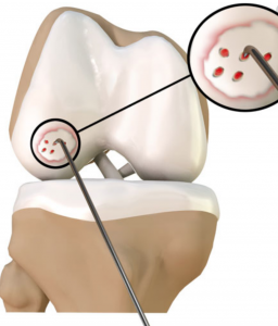 Arthroscopic Chondroplasty