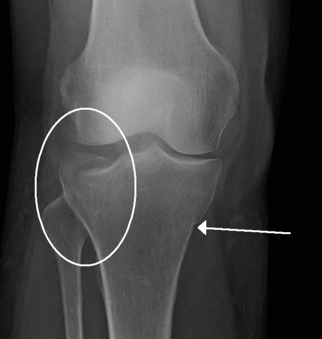 Tibial Plateau Fracture Mri