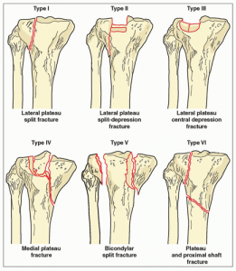 tibial plateau fracture