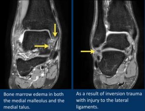 bone marrow edema