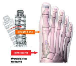 lapiplasty bunion correction