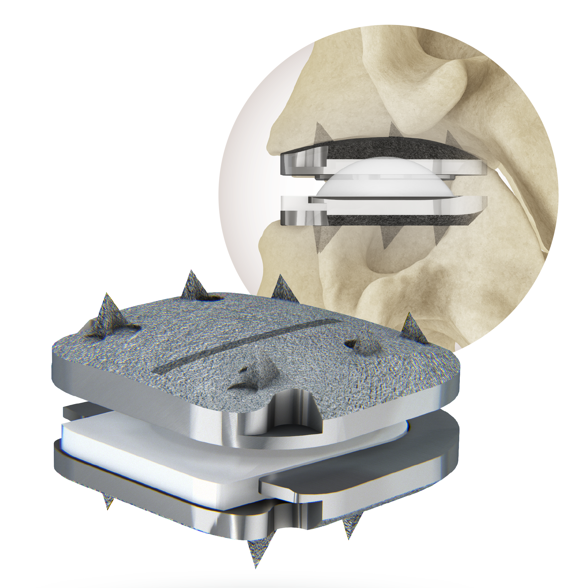 hero-prodisc-c-vivo-and-anatomical-model prodisc C Vivo implant and anatomical model with device implanted